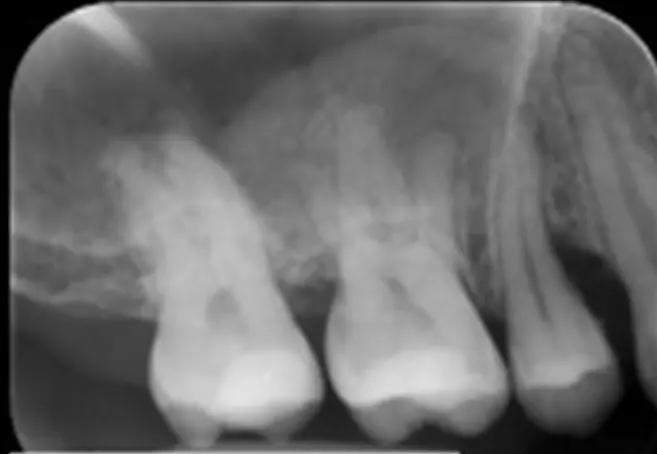 preop-regeneration-1